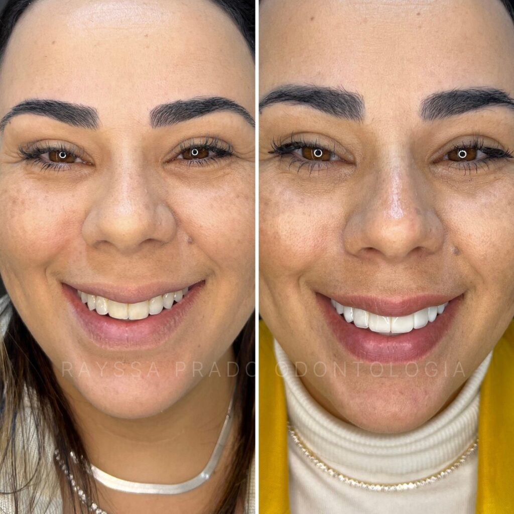 lentes e facetas em resina composta em uberaba dra rayssa prado macedo (5)