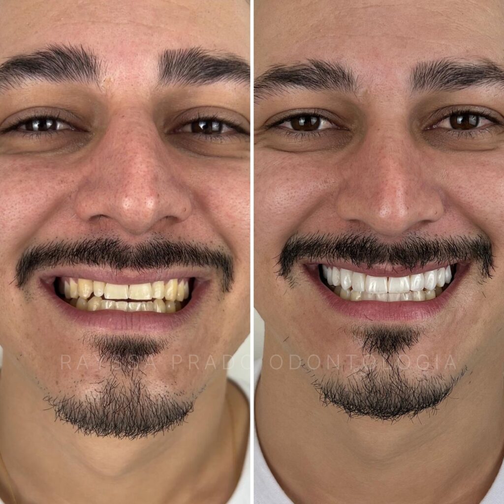 facetas em resina composta antes e depois rayssa prado odontologia uberaba 2