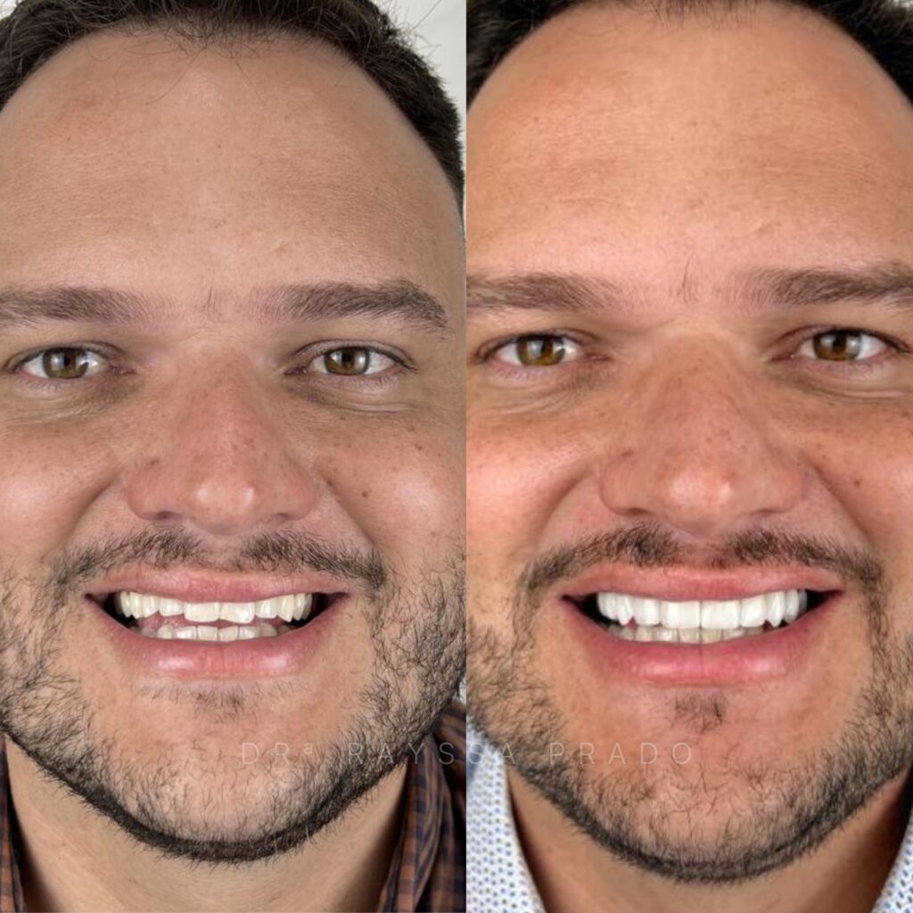 facetas em resina composta em uberaba mg cabo diego fabiano dra rayssa prado macedo rayssa prado odontologia (1)
