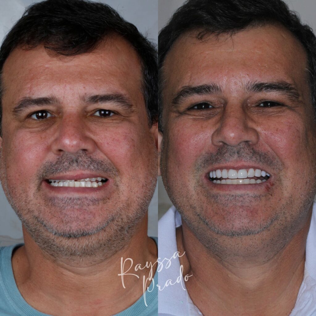lentes em resina antes e depois - dra rayssa prado macedo - uberaba (1)