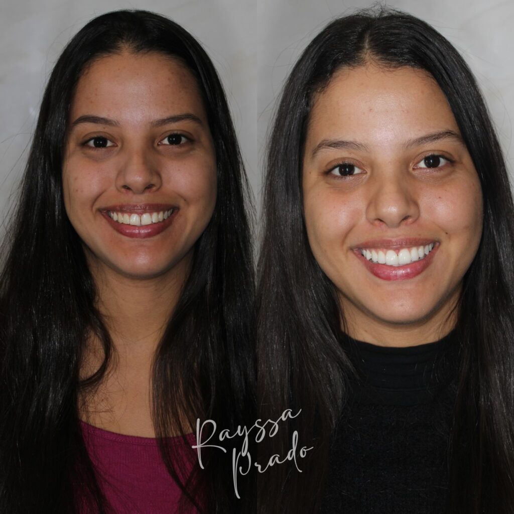 lentes em resina antes e depois - dra rayssa prado macedo - uberaba (2)