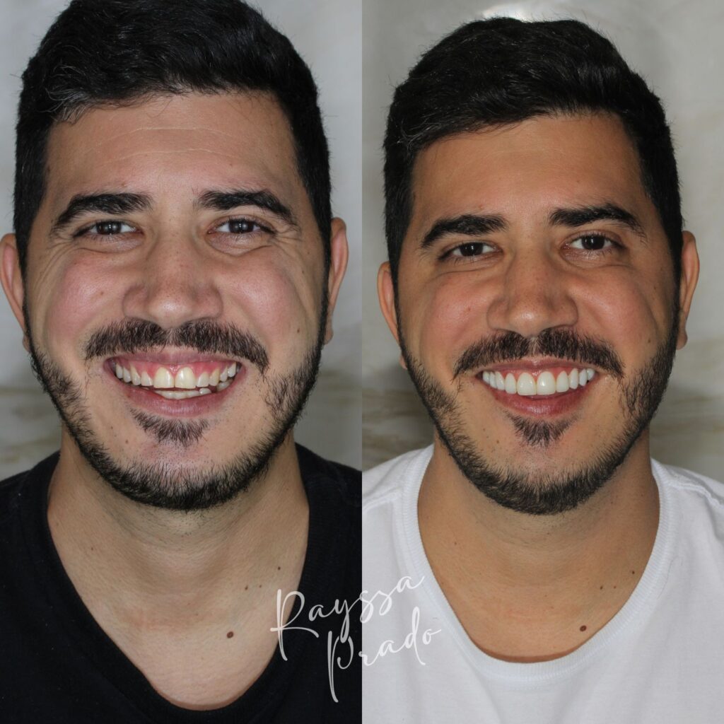 lentes em resina antes e depois - dra rayssa prado macedo - uberaba (4)