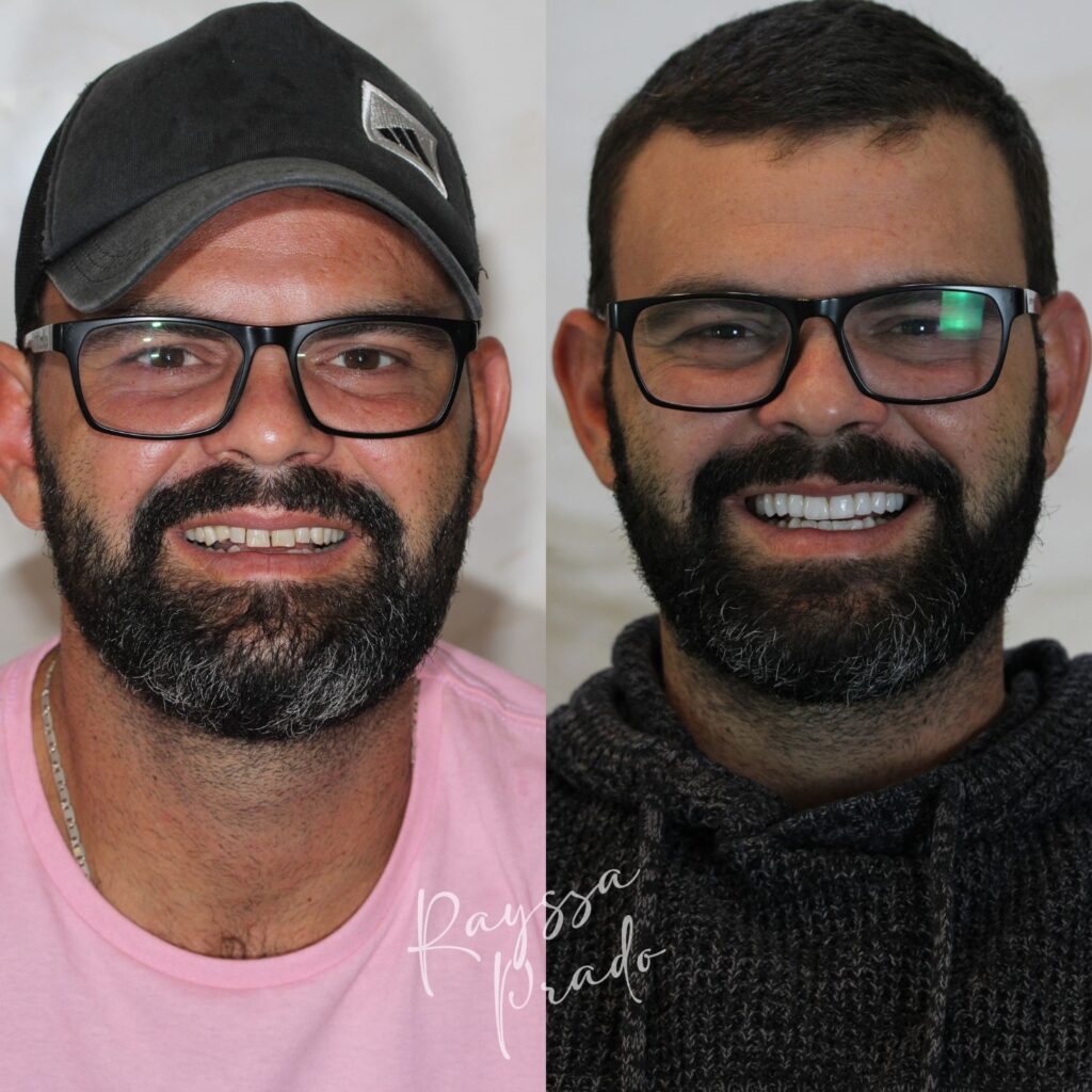 lentes em resina antes e depois - dra rayssa prado macedo - uberaba (6)