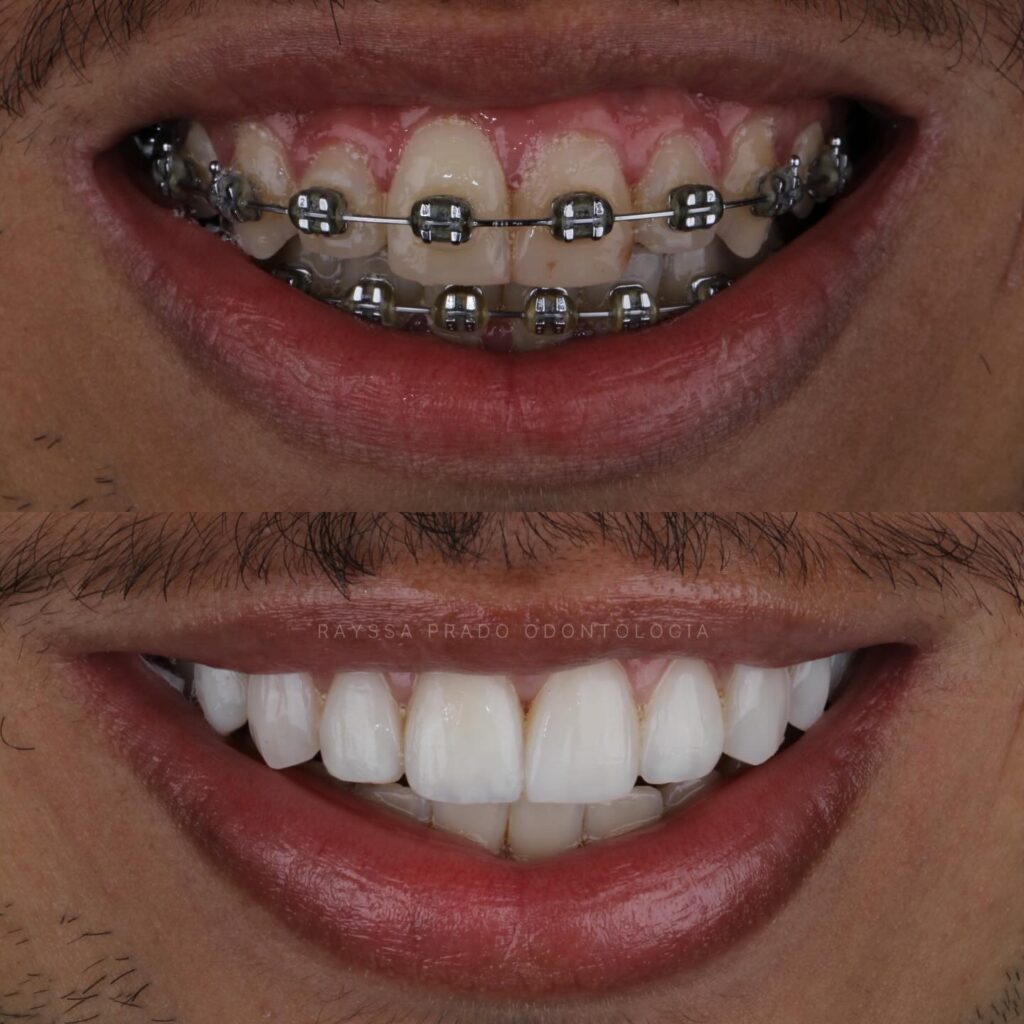 lentes em resina em uberaba - dra rayssa prado 2