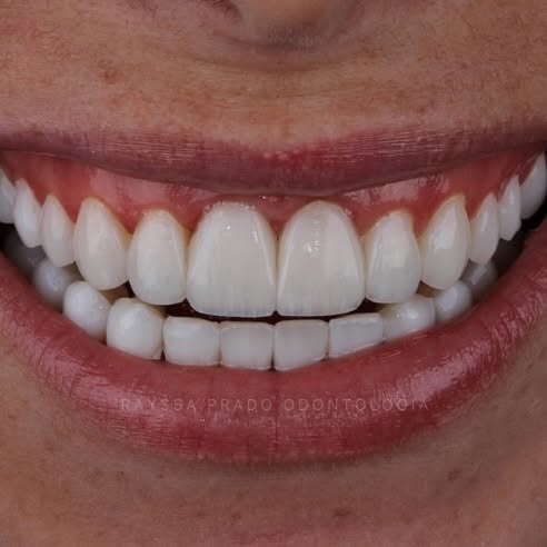 lentes em resina em uberaba - dra rayssa prado 3