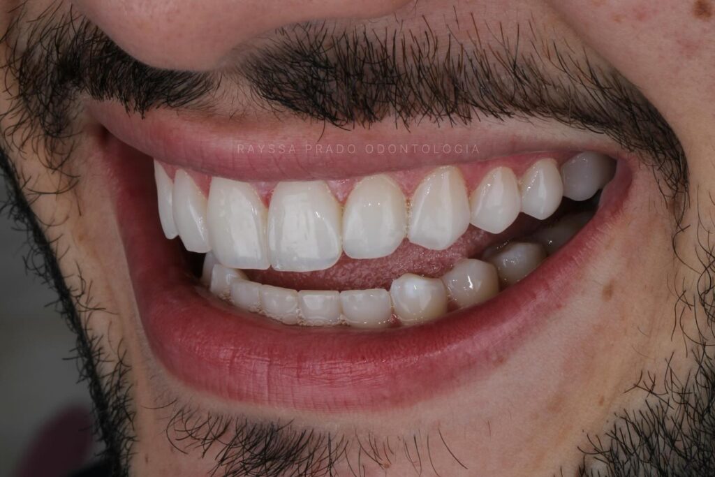 lentes em resina em uberaba - dra rayssa prado 4