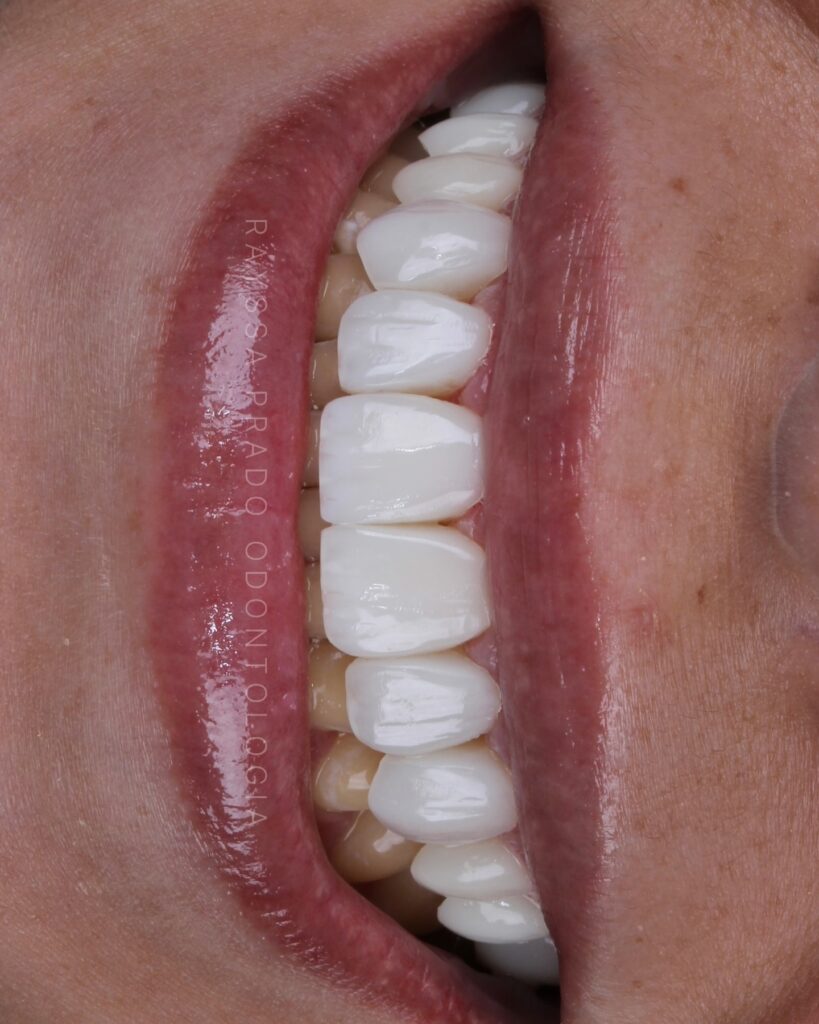 lentes em resina em uberaba - dra rayssa prado 5